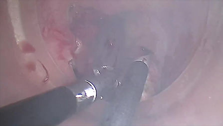 1.Transanal Resection Video-Assisted for Early-Stage Rectal Cancer.